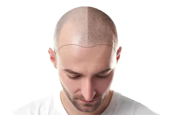 THINGS TO BE CONSIDERED BEFORE UNDERGOING HAIR TRANSPLANT SURGERY