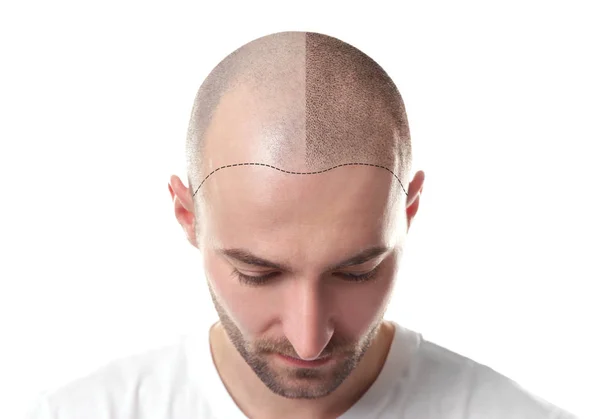 Hair Transplantation is a surgical procedure