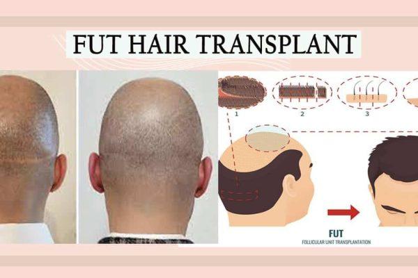 Facts to know about Follicular Unit Transplantation (FUT) in Hair Restoration Surgery