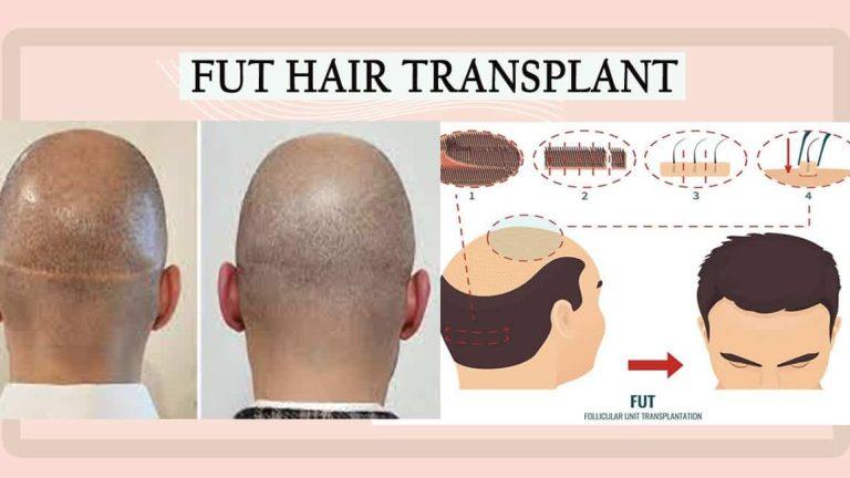 FUT Hair Transplant