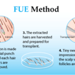 FUE Hair Transplant Technique