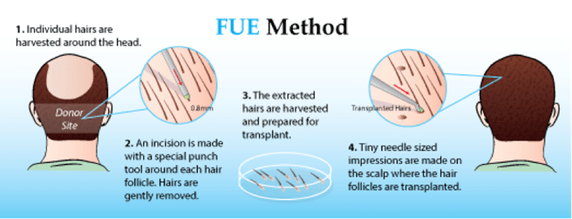 FUE Hair Transplant Technique