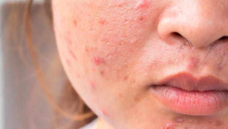 Acne Scars treatment