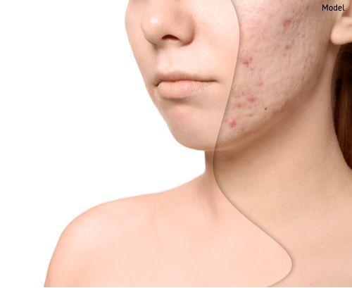Best Acne Scars treatment