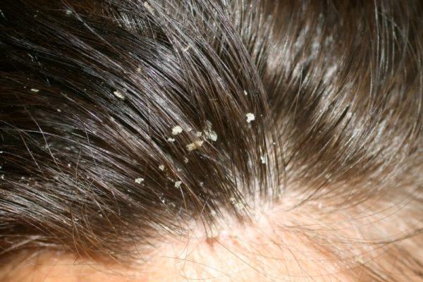 What is Dandruff and How Does it Trigger Hair Fall ? Know How To Manage it