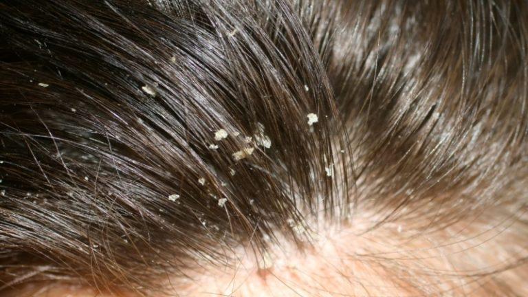 Dandruff-Treatment-in-Hyderabad, India