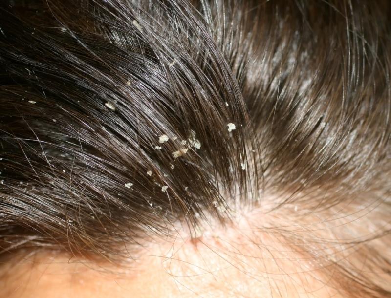 Hair With Dandruff
