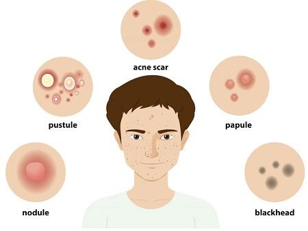 Know About Different Types Of Acne, Causes, and Symptoms