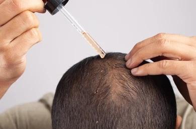 Topical Minoxidil Use In Treating Patterned Hairloss