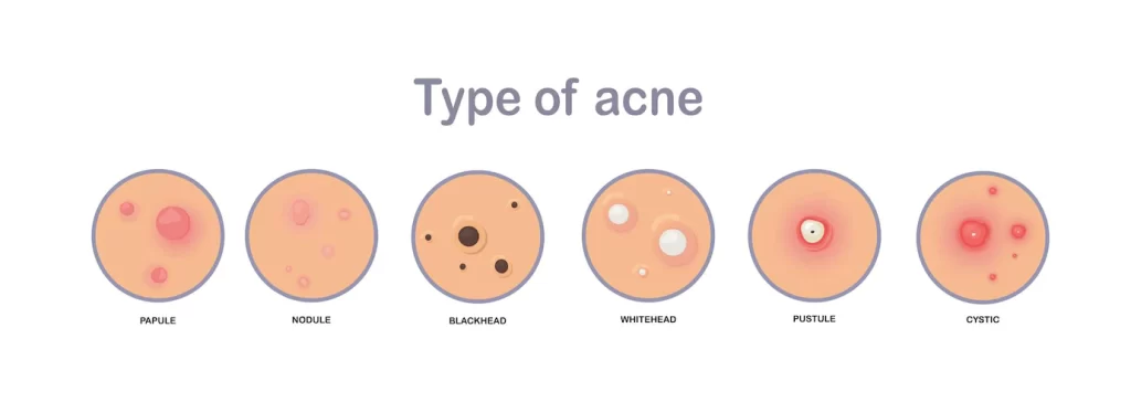 Types of acne