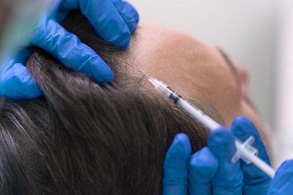 GFC Treatment & Its Benefits For Treating Hair Loss