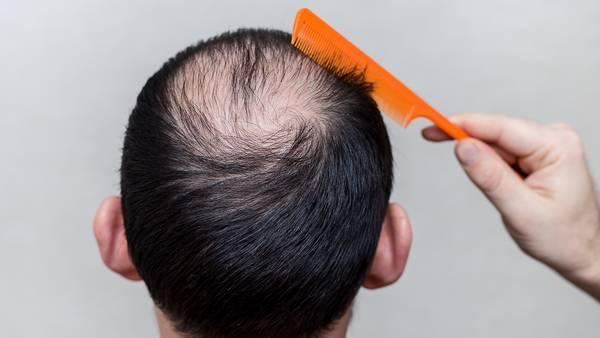 Best Hair Loss Treatment