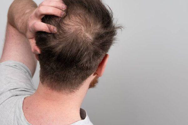 All You Need To Know About Male Pattern Baldness