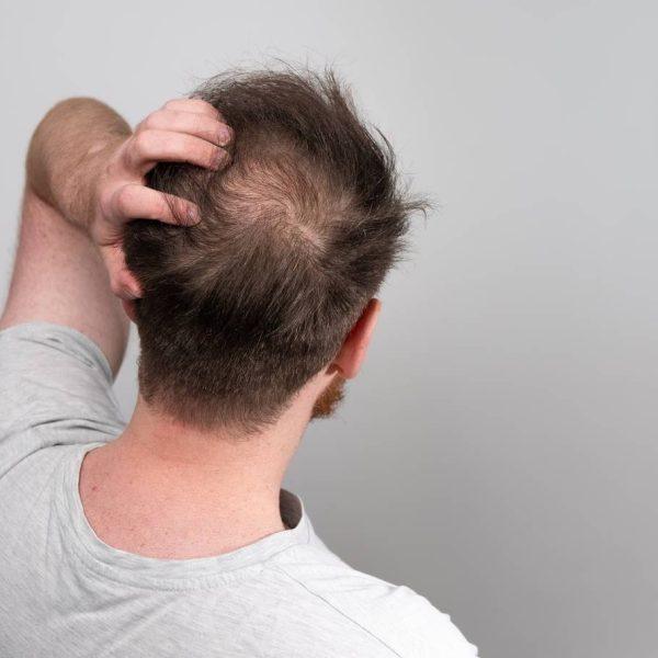 All You Need To Know About Male Pattern Baldness