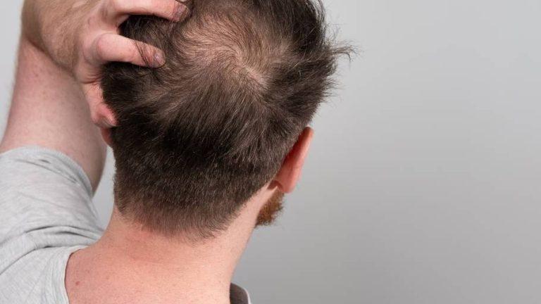 Male Pattern Baldness