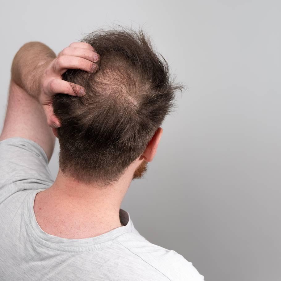 Hair Loss and Male Pattern Baldness Androgenic Alopecia  Young Mens  Health