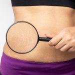 Best Stretch Marks Removal Treatment
