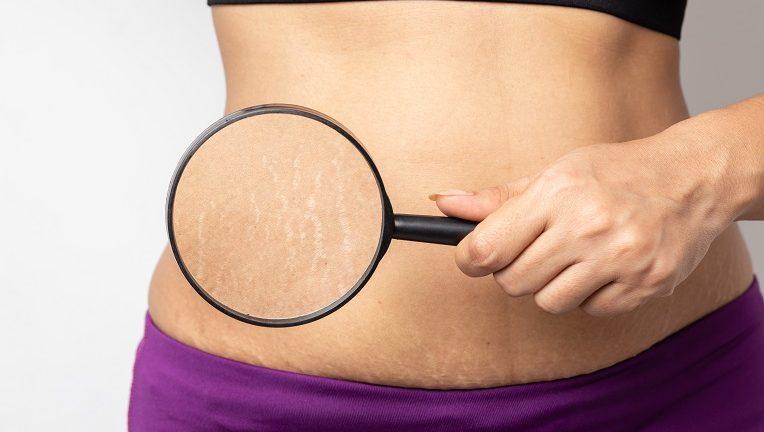 Best Stretch Marks Removal Treatment