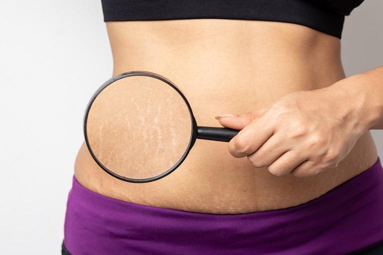 How Laser Treatment Helps in Stretch Marks Removal
