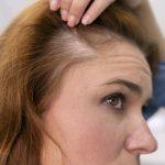 Female Pattern Baldness
