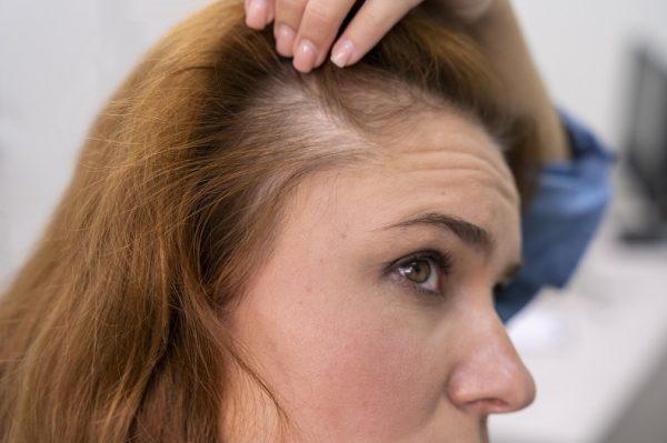 Know About Female Pattern Baldness Symptoms & Treatment Options