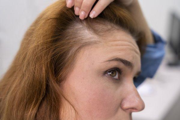 Know About Female Pattern Baldness Symptoms & Treatment Options