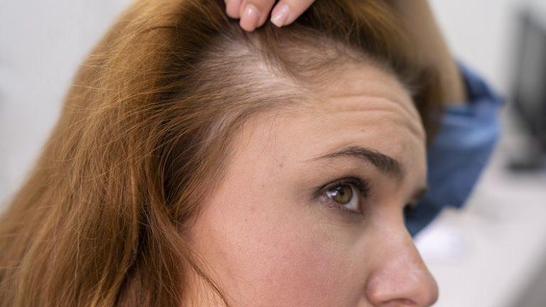 Hair Loss, Hair Thinning, Balding – Anxiety Symptoms - AnxietyCentre.com