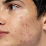 Best Acne Treatment in Hyderabad
