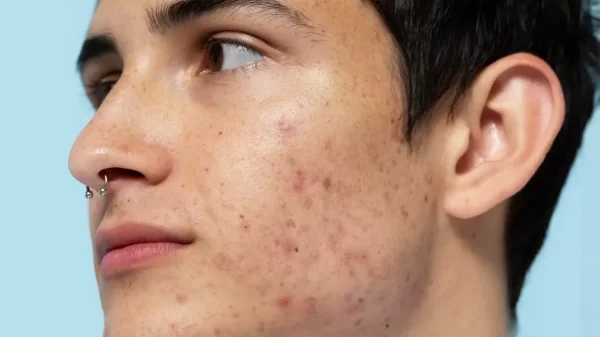 Best Acne Treatments & Tips Suggested By Dermatologist