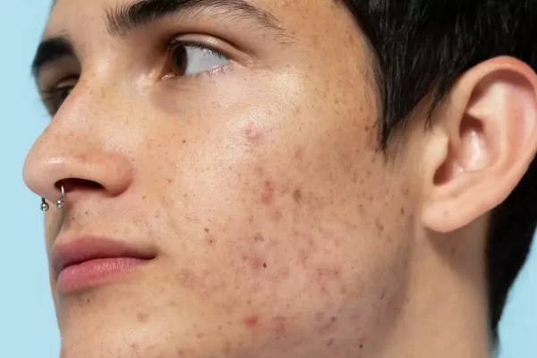 Best Acne Treatments & Tips Suggested By Dermatologist