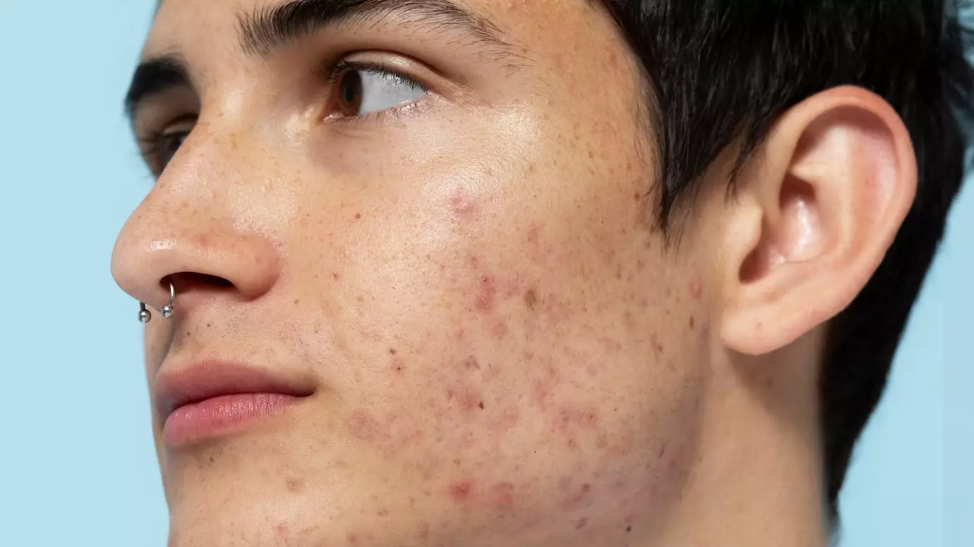 Best Acne Treatments & Tips Suggested By Dermatologists