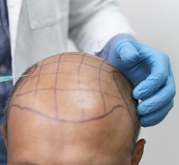 Best Hair Transplant Clinic in Hyderabad