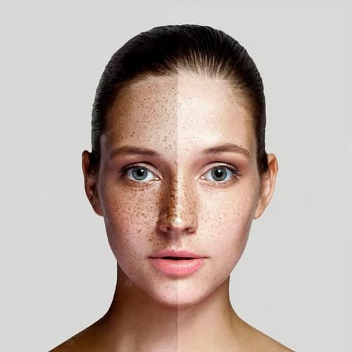 Unveil Radiant & Healthy Skin With Best Pigmentation Treatments