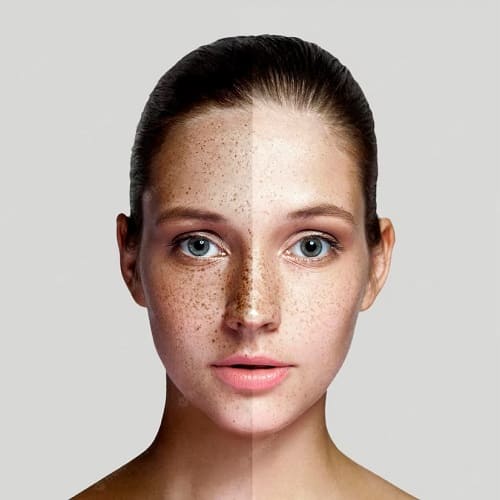 Best Pigmentation Treatments in Hyderabad