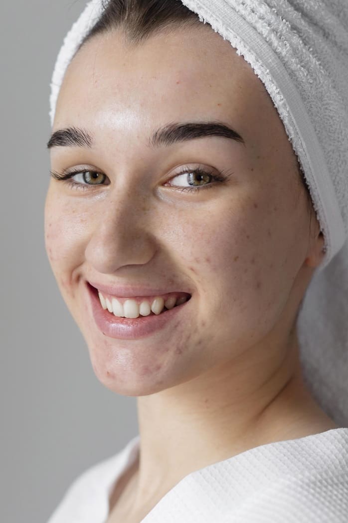 Effective Dermatological Procedures for Treating Pimples