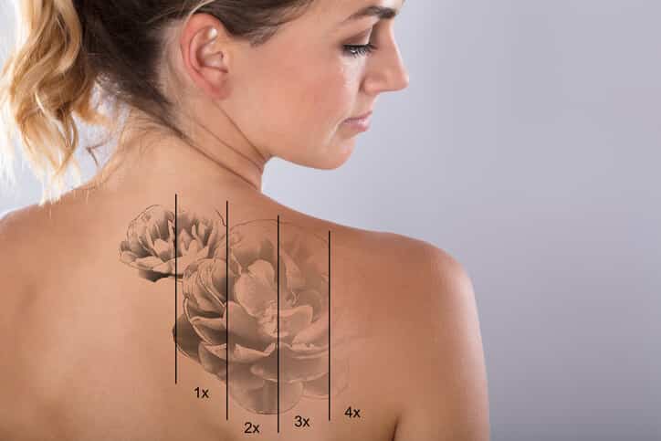 Laser Tattoo Removal Treatment