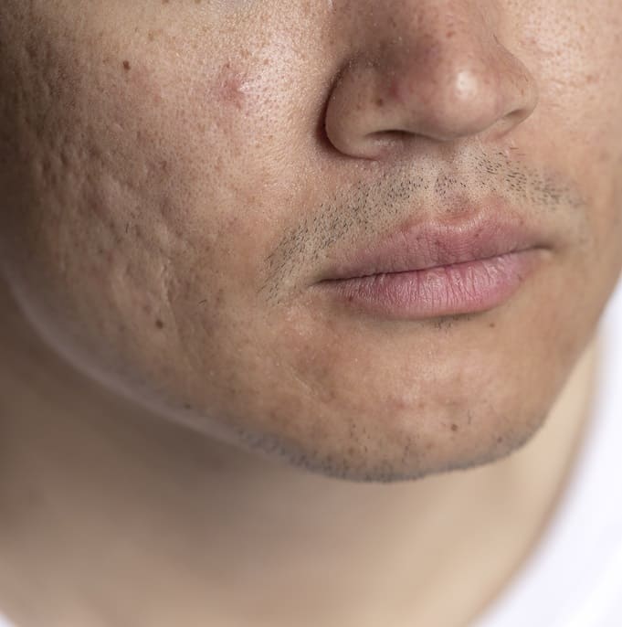 Transforming Skin: The Magic of Fractional Laser Treatment for Acne Scars