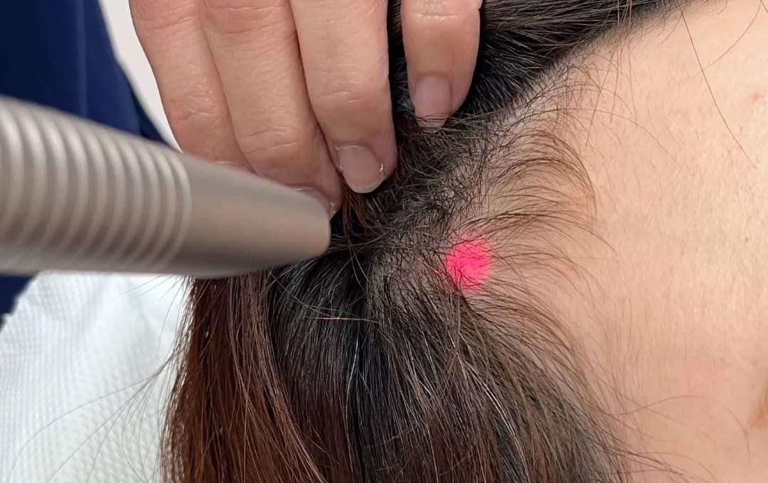 Effective Laser Treatments for Hair Growth