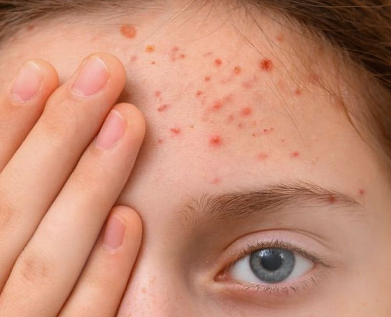 Unmasking Forehead Acne: Causes, Symptoms, and Effective Treatments