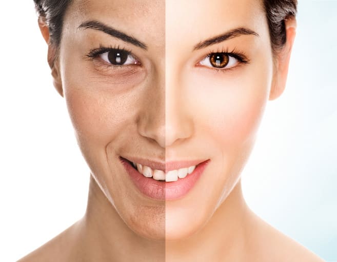 Cosmelan Peel Treatment