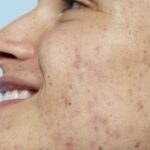 Best Acne Scar Treatment in Hyderabad