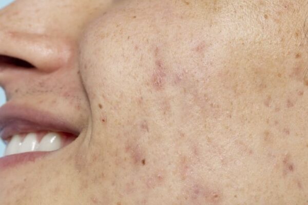 Preparing for Acne Scar Treatment: Tips and Advice from Dermatologists