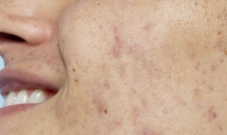 Best Acne Scar Treatment in Hyderabad