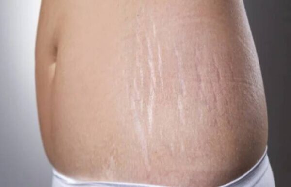 Top 5 Stretch Mark Removal Treatments: Effective Solutions to Achieve Smoother Skin