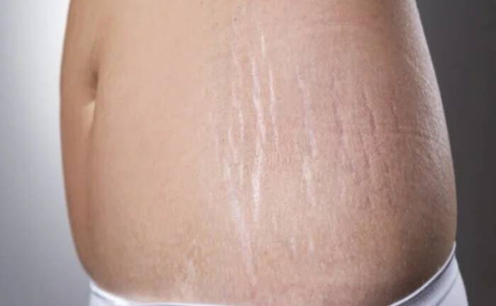 Stretch Marks Treatment