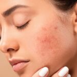Hormonal Acne Treatment