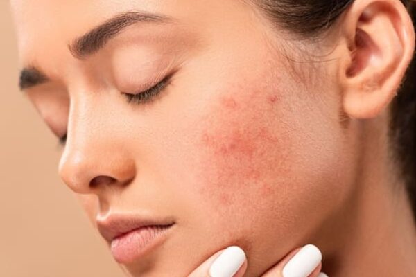Hormonal Acne Causes,Symptoms & Effective Treatments suggested by Dermatologist