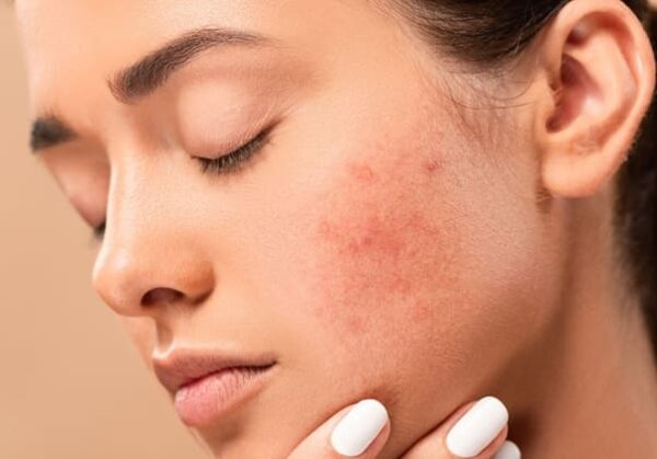 Hormonal Acne Causes,Symptoms & Effective Treatments suggested by Dermatologist