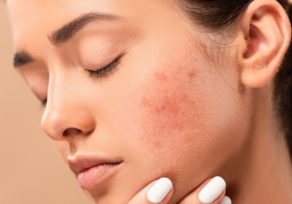 Hormonal Acne Treatment
