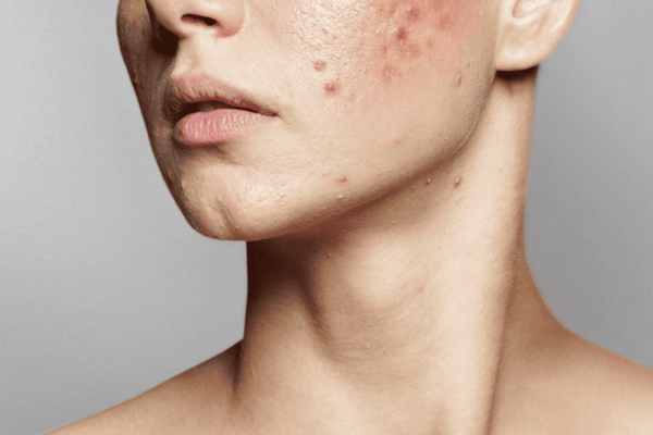 Acne Scars Treatments & What Really Works: A Comprehensive Guide